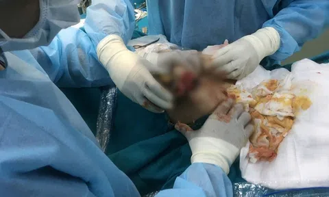 Tiêm silicon suốt 3 năm, nữ Việt kiều suýt hỏng ngực khiến dân tình khóc thét