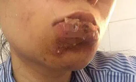 Nhập viện vì cả tin vào quảng cáo \'căng mọng, tròn đầy\'
