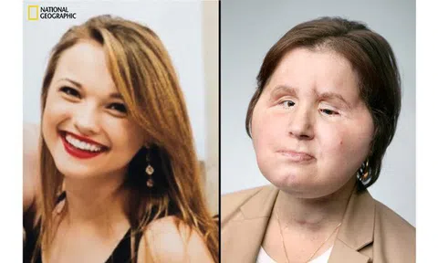 Ca phẫu thuật lịch sử dài 31 giờ trả lại gương mặt xinh đẹp cho cô gái 21 tuổi