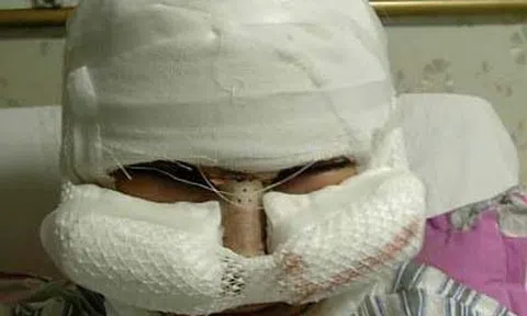 Cô gái 19 tuổi nhận kết đắng sau phẫu thuật: \'Chỉ mong khuôn mặt trở lại bình thường\'