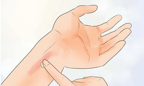 4 mẹo đơn giản điều trị vết bỏng nhẹ tại nhà