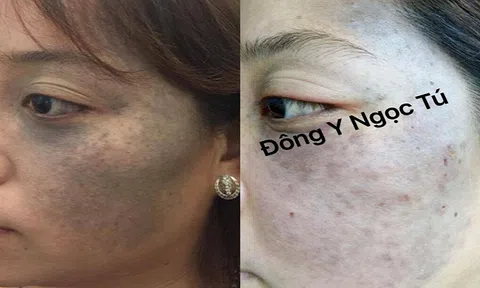 Liệu pháp Đông Y mới, đánh tan vết chàm bẩm sinh