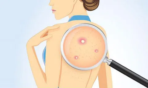 Mách bạn 7 cách trị mụn lưng bằng nguyên liệu thiên nhiên, hiệu quả bất ngờ
