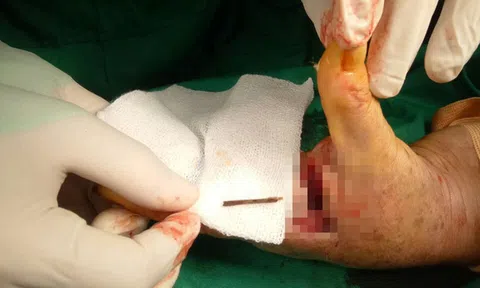 Mất 3 năm với 3 lần phẫu thuật để lấy cọng dằm tàu dừa trong bàn tay