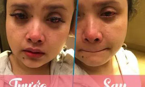 Cô gái trẻ ôm hận cả đời vì mê làm đẹp đi nối mi giả mất luôn mi thật