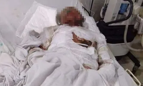 Vợ đốt xăng tự tử khiến cả gia đình bỏng nặng