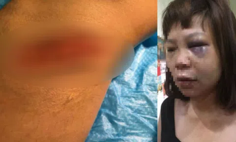 Triệu tập người chồng vũ phu đưa vợ lên đồi đánh đập dã man, cắt tóc, cắt gân chân
