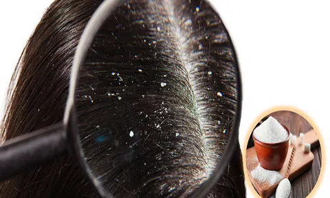 Trị gàu sẽ cực đơn giản khi các nàng biết sử dụng lọ đường sẵn có trong bếp