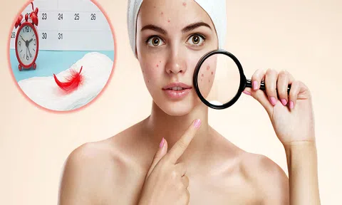 Nằm lòng 4 nguyên tắc này da của bạn sẽ chẳng còn lo mụn nổi ầm ầm `mùa dâu rụng`