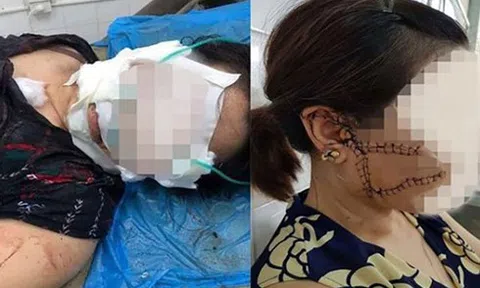 Thông tin mới nhất vụ chồng dùng dao rạch mặt, cắt gân chân `vợ hờ` ở Bắc Giang