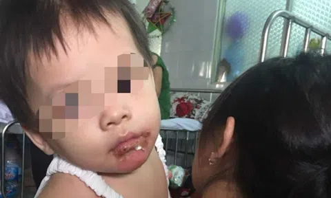 TPHCM: Mẹ đơn thân `tố` bảo mẫu đổ nước sôi khiến con gái 18 tháng tuổi bỏng nặng