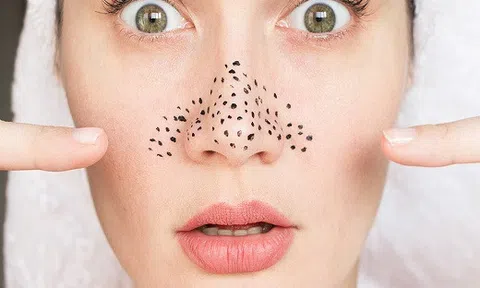 Rút gọn các bước trị mụn đầu đen cứng đầu chỉ với mặt nạ lòng trắng trứng