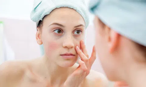 Không phải nặn mụn, đây mới là cách trị mụn đầu đen ở mũi chuẩn nhất!