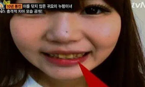 Cô gái không đánh răng suốt 10 năm, hễ mở miệng là khiến người xung quanh bỏ chạy