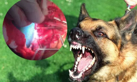  Bé trai 2 tuổi bị chó becgie 40kg cắn rạn sọ, lòi nhãn cầu