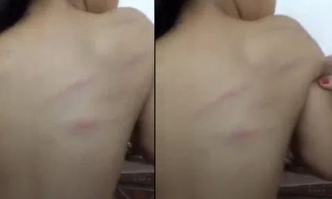 Nghi vấn cô giáo chủ nhiệm đánh bầm lưng học sinh lớp 1 vì lười học
