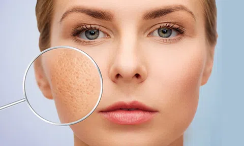 Tự làm hỗn hợp se khít lỗ chân lông bằng nguyên liệu có trong nhà bếp