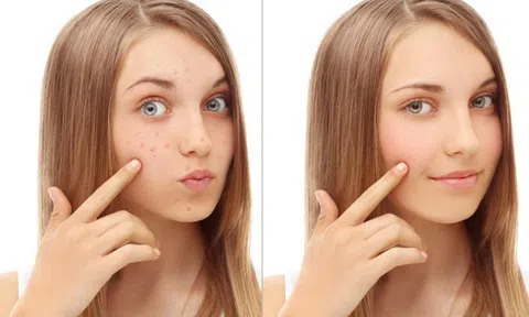 Trị mụn ẩn bằng mật ong lấy lại làn da mịn màng cho phụ nữ