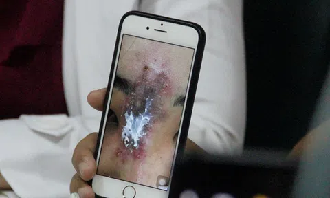 Làm đẹp bằng tiêm filler, nữ sinh viên bị hoại tử mũi