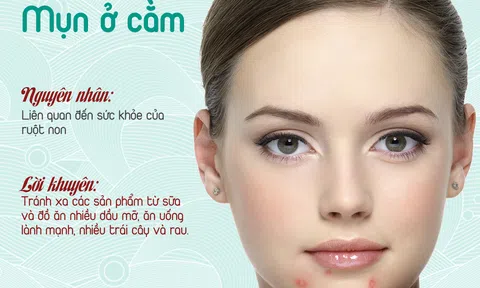 Mụn ở cằm: Nguyên nhân và cách điều trị phù hợp 