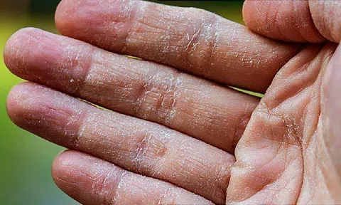 Không ngờ những thứ này có thể trị da chân tay khô nứt nẻ vào mùa đông