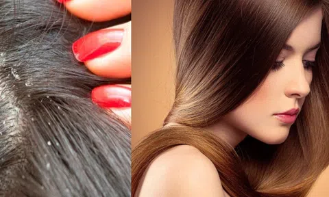 Hé lộ công thức trị gàu vĩnh viễn ngay tại nhà với muối