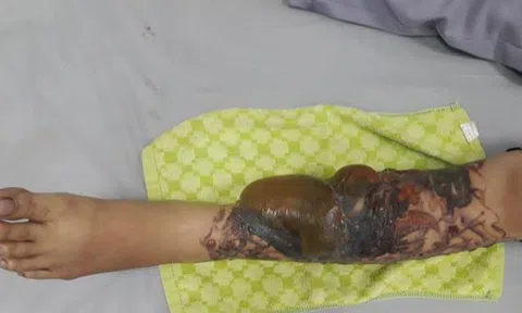 Cô gái trẻ bị hoại tử chân, lộ cả gân vì xoá hình xăm bằng laser