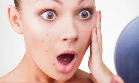 3 cách trị mụn hiệu quả nhất chỉ bằng những nguyên liệu có ngay trong bếp của bạn