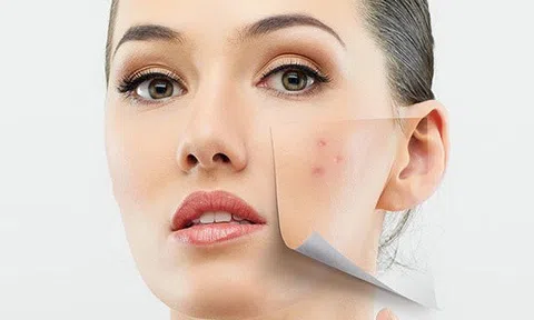 Sử dụng công thức này tiêu diệt mụn ẩn tận gốc