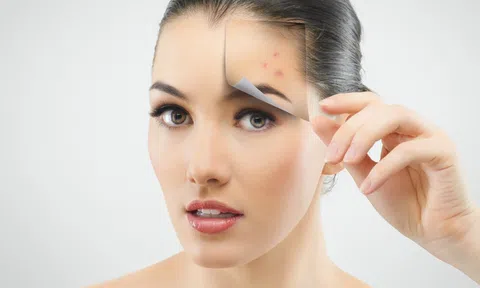 3 cách trị mụn thâm hiệu quả tại nhà