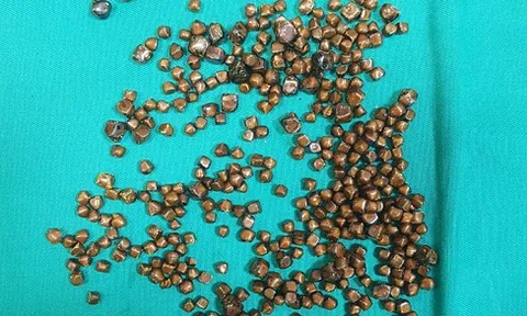 Kinh hoàng: Nữ bệnh nhân có 400 viên sỏi trong túi mật 