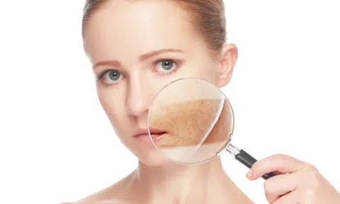 Điều trị nám tận gốc chỉ nhờ những thực phẩm quen thuộc này