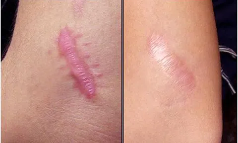 Đây là công thức thần thánh chữa sạch sẹo lồi chị em cần bỏ túi ngay