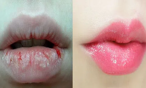 Nguyên nhân và cách trị môi khô nứt nẻ hiệu quả mà không tốn thời gian