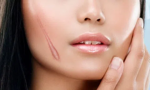 Học ngay cách trị sẹo đơn giản hiệu quả tại nhà