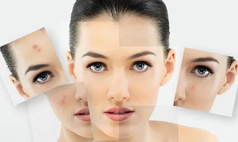 Bí quyết chăm do da mụn cho chị em không để lại vết thâm