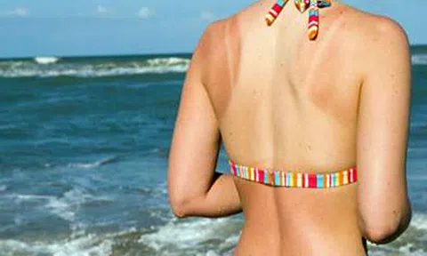 Mẹo hay phục hồi làn da bị cháy nắng