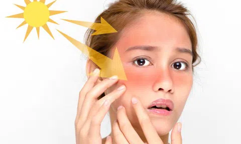 Cách phục hồi da bị cháy nắng siêu tốc từ nguyên liệu có sẵn trong nhà bếp