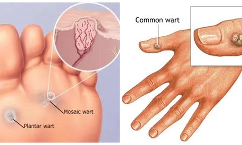 Mẹo hay `đánh bay` mụn cóc bằng nguyên liệu tự nhiên này