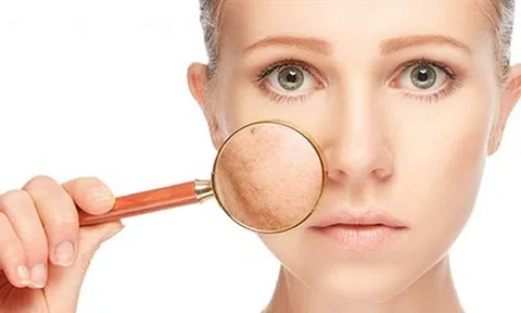 Mẹo hay` đánh bay` nám hai bên gò má