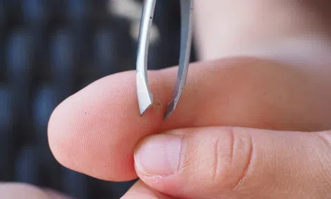 Mẹo hay lấy dằm khỏi tay mà không đau