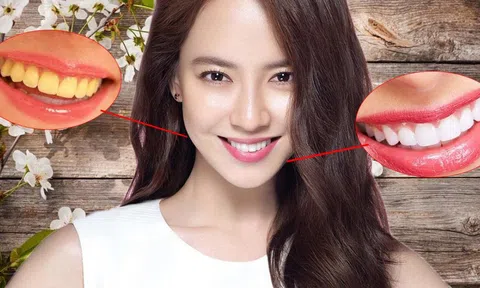 Bật mí cách đơn giản ngay tại nhà giúp răng ố vàng trở nên sáng bóng