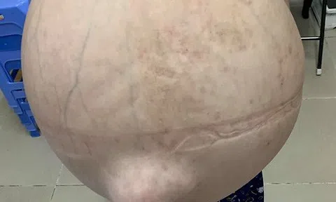 Rút hơn 40 lít nước trong bụng cứu cô gái `cõng` khối u khổng lồ, y văn thế giới mới
