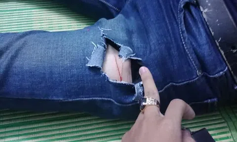 Nam sinh Sài Gòn bị côn đồ dùng dao lam rạch chân cướp tài sản