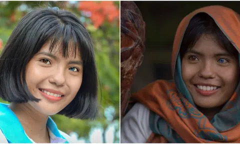 Bác sĩ lý giải nguyên nhân nữ sinh có hai màu mắt đen, xanh