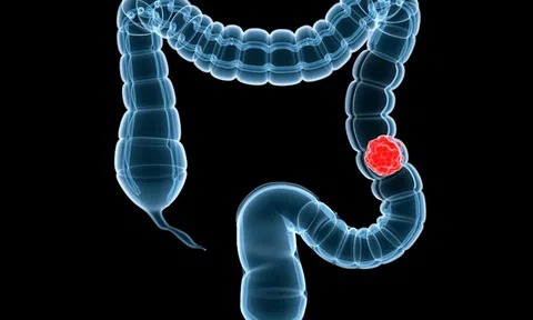 Tai sao mọi người nên xét nghiệm tầm soát ung thư đại trực tràng?