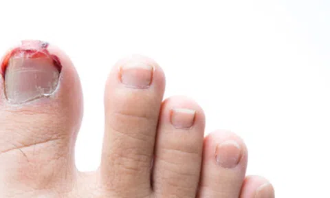 Đau phát khóc vì móng chân mọc ngược, phải làm gì?