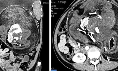 Mang song thai suốt 17 năm không hề hay biết