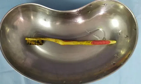 Nuốt nguyên chiếc bàn chải đánh răng 18cm vào bụng mà không hề hay biết