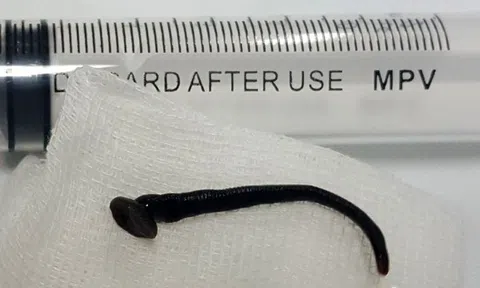 Kinh hoàng thanh niên 9X bị con đỉa dài 3cm chui vào thanh quản